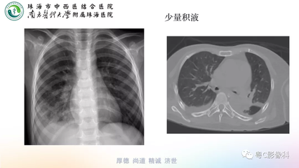 肋骨骨折拍ct多少钱