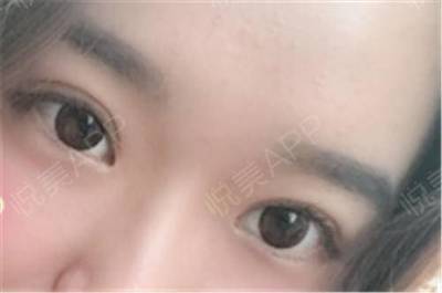 双眼皮一会有一会没有