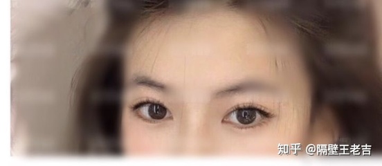 双眼皮如何修复