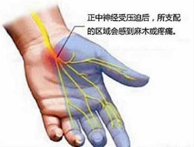 手关节腱鞘炎怎么治疗