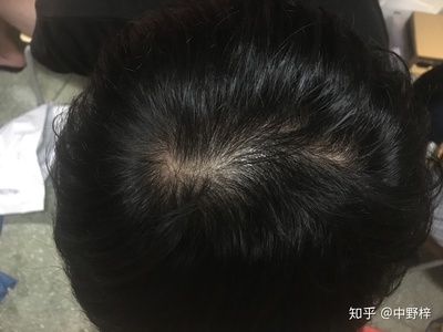 天天掉头发是怎么回事