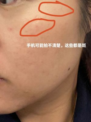 微针祛斑效果怎么样