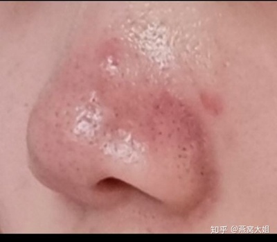 鼻头鼻头有红色的痘痘