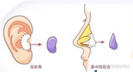 取耳软骨隆鼻疼吗