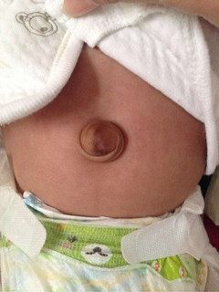 1岁宝宝肚脐突出照片