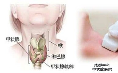 甲状腺有炎症怎么治疗