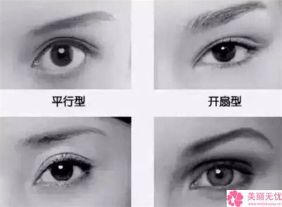 割双眼皮变内双