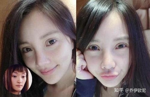 割了双眼皮后特后悔