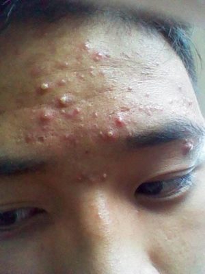 挤痘痘鼻子肿了