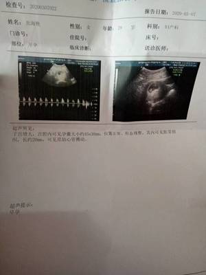 双侧卵巢多囊会怀孕吗