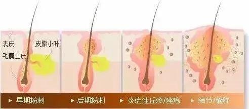 怎样使痘痘快速消肿