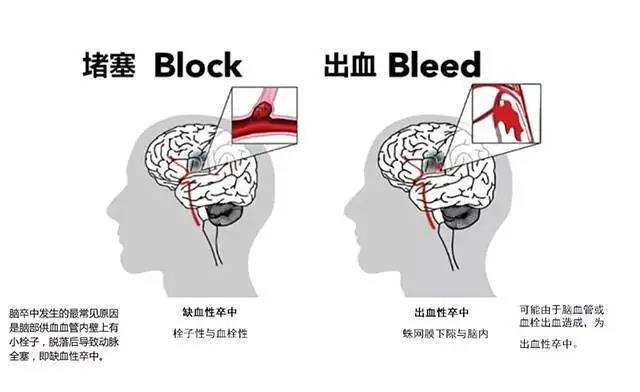 脑梗阻怎么治疗