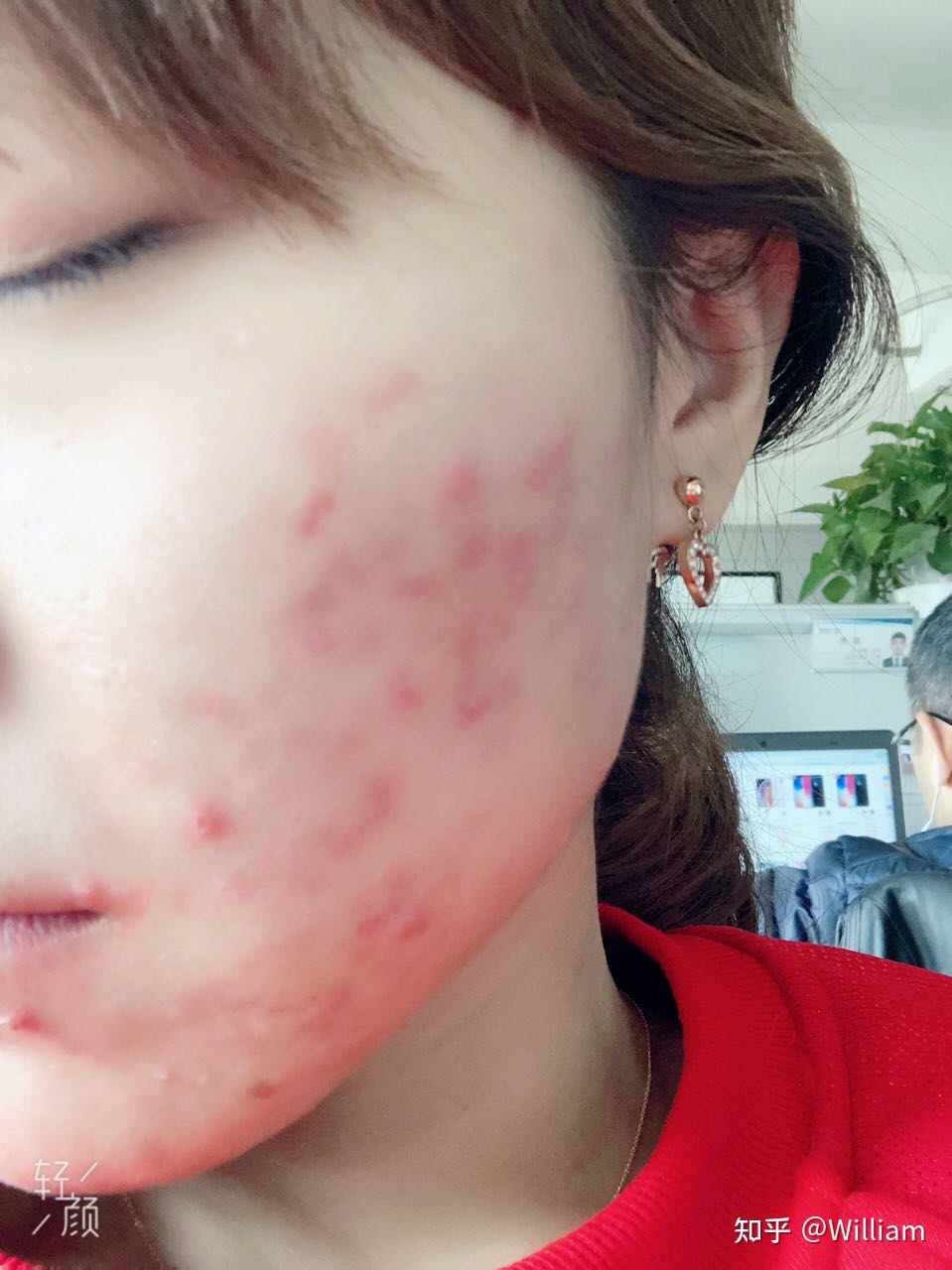脸上痘痘里的白色东西是什么