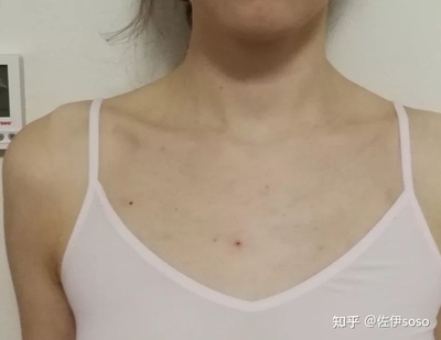 胸前总是长痘痘是什么原因