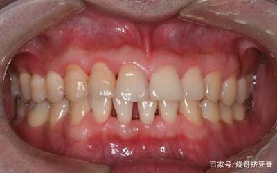牙齿松动疼怎么治疗