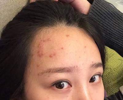 痘痘老是不好_好烦