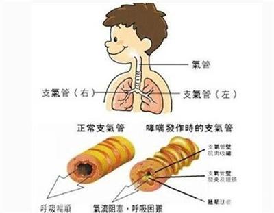 支气管炎哮喘怎么治疗才能除根