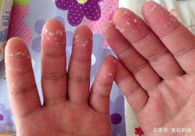 小孩手蜕皮是怎么回事