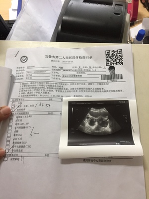 排卵期囊肿
