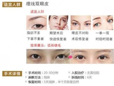 埋线双眼皮多久恢复正常