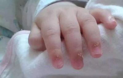 宝宝手指起倒刺是缺什么