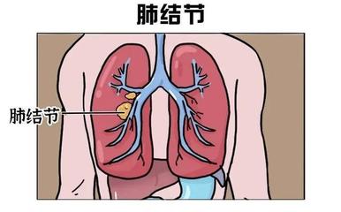 肺结节是怎么回事