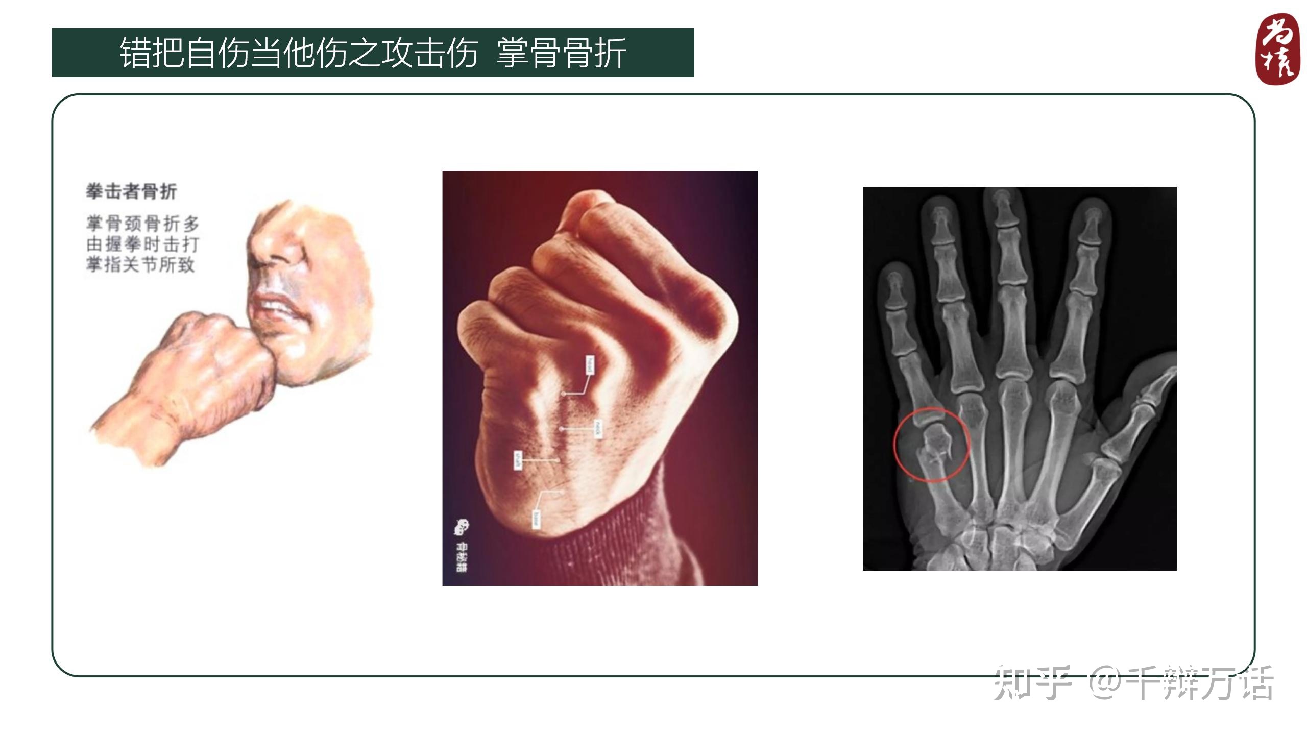 掌骨骨折算轻伤吗