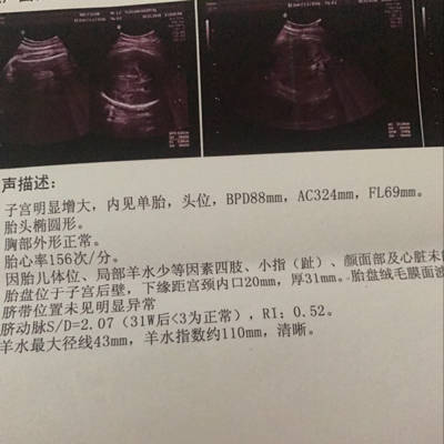 胎儿fl标准对照表