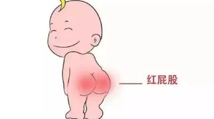 宝宝屁股溃烂怎么办
