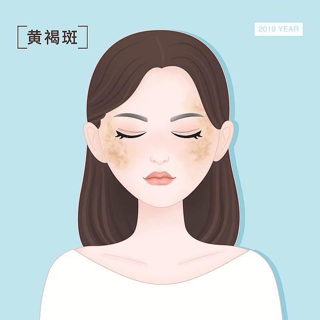 皮秒祛斑后脸上长痘