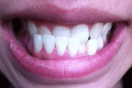 孩子牙齿间隙大
