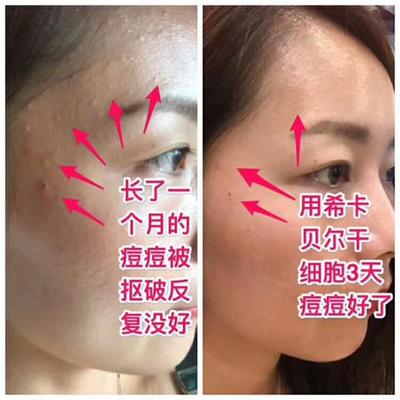 痘痘破了用不用挤