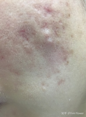 痘好了变成白色痘印