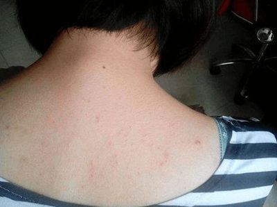 背上长湿毒痘痘擦什么药
