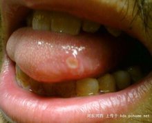 舌头长溃疡是怎么回事