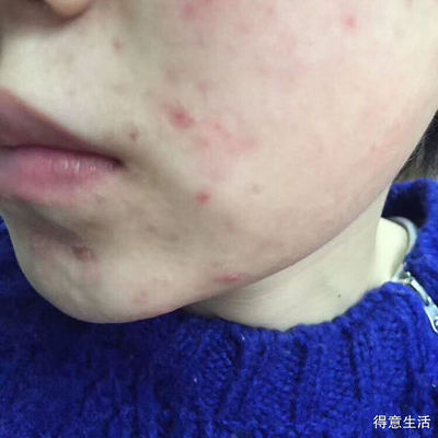 中药对痘痘有用吗