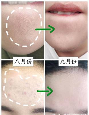 闭口痘痘粗糙