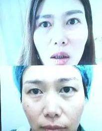 35岁割双眼皮