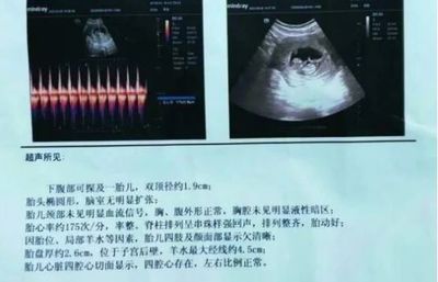 胎儿死亡赔偿标准