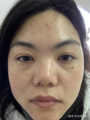南京激光祛痘痘该去哪里
