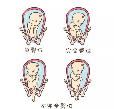 胎膜早破对胎儿影响