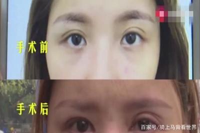为什么双眼皮会变成三眼皮