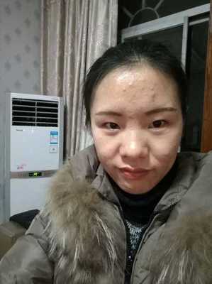 南通哪里看痘痘