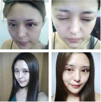 全切双眼皮拆线后