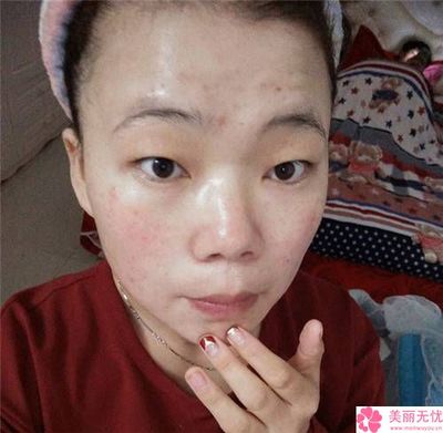 激光治疗痘痘需要注意什么