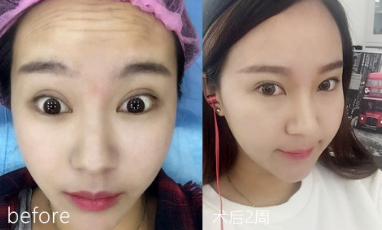 玻尿酸去抬头纹能保持
