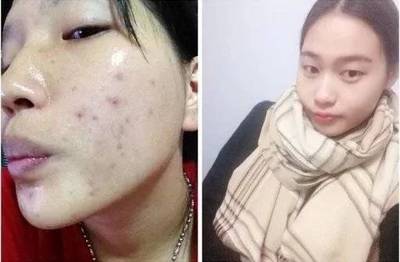 怎样祛痘痘印小妙招