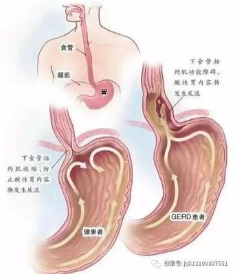 食道反酸是怎么回事