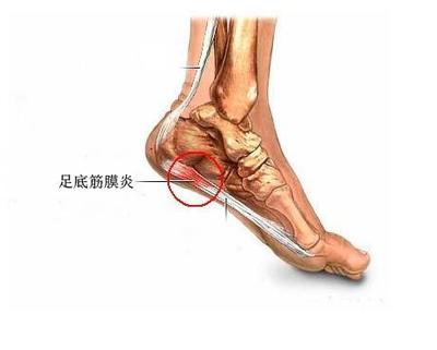 脚跟长骨刺怎么治疗