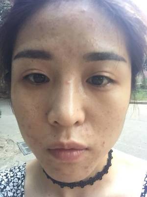 满脸痘痘用什么好